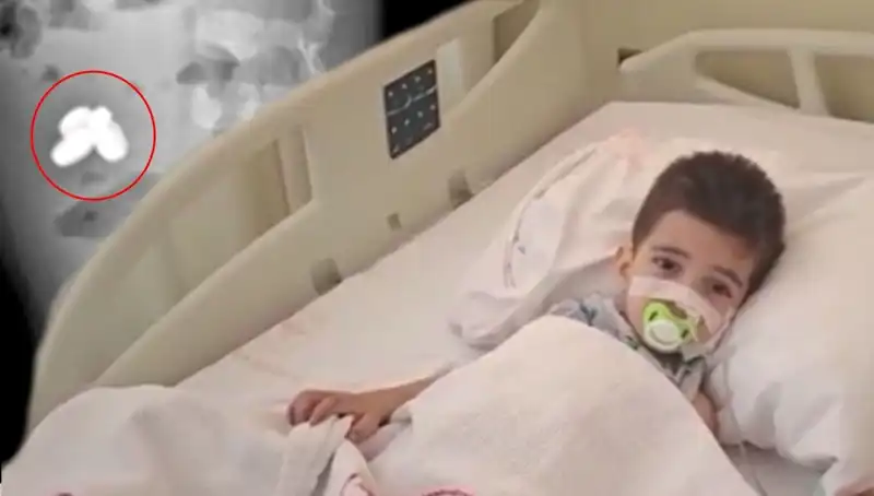 Pil ve Mıknatıs Yutan Çocuğun Bağırsakları Yandı: Hayat Kurtaran Müdahale